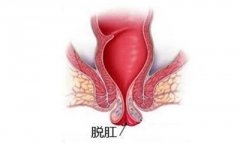 <b>为何会经常性脱肛？</b>