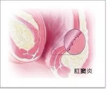 <b>日常生活中如何预防肛窦炎</b>
