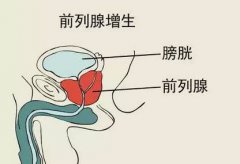 <b>【博爱 健康】前列腺增生是怎么形成的？</b>